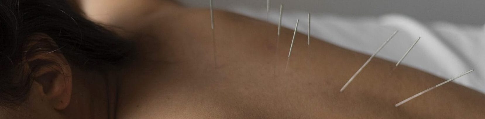 Fisioterapeuta aplicando punción seca en un paciente con dolor miofascial en Guadalajara